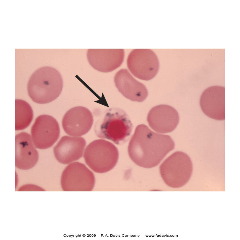 <p><span data-name="drop_of_blood" data-type="emoji">🩸</span><strong> Peripheral Blood Smear (Wright Stain):</strong></p><p><span data-name="small_blue_diamond" data-type="emoji">🔹</span> <strong>Normocytic/Normochromic OR Microcytic/Hypochromic RBCs</strong> – Depends on severity.<br><span data-name="small_blue_diamond" data-type="emoji">🔹</span> <strong>Definite Anisocytosis</strong> – High RDW.<br><span data-name="small_blue_diamond" data-type="emoji">🔹</span> <strong>Target Cells</strong> – Iron dysregulation.<br><span data-name="small_blue_diamond" data-type="emoji">🔹</span> <strong>Basophilic Stippling</strong> – Aggregated ribosomes (seen in lead poisoning &amp; some sideroblastic anemias).<br><span data-name="small_blue_diamond" data-type="emoji">🔹</span> <strong>Pappenheimer Bodies</strong> – Iron deposits inside RBCs (<strong>KEY Clue for Sideroblastic Anemia!</strong>).</p>