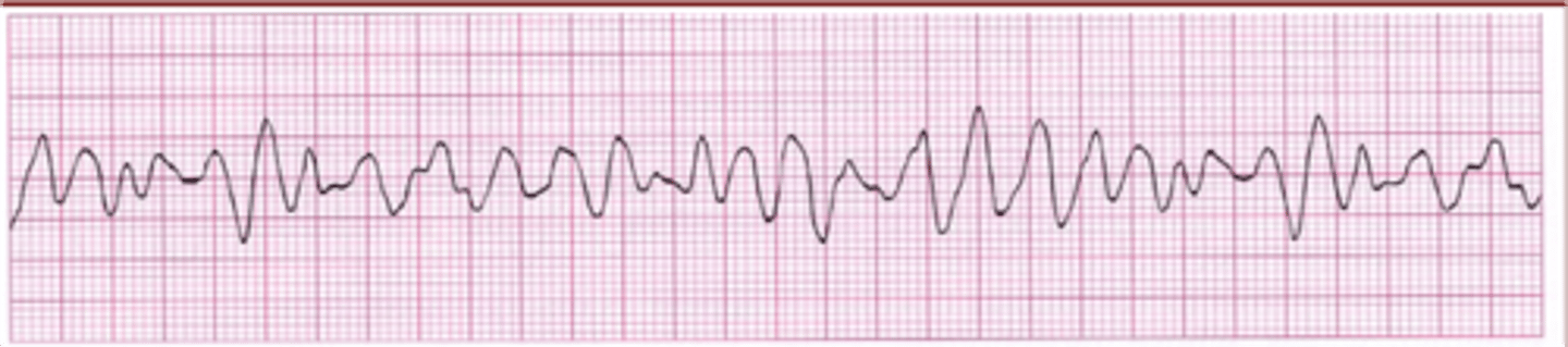 <p>Chopy but not as high as polymorphic V tach</p>