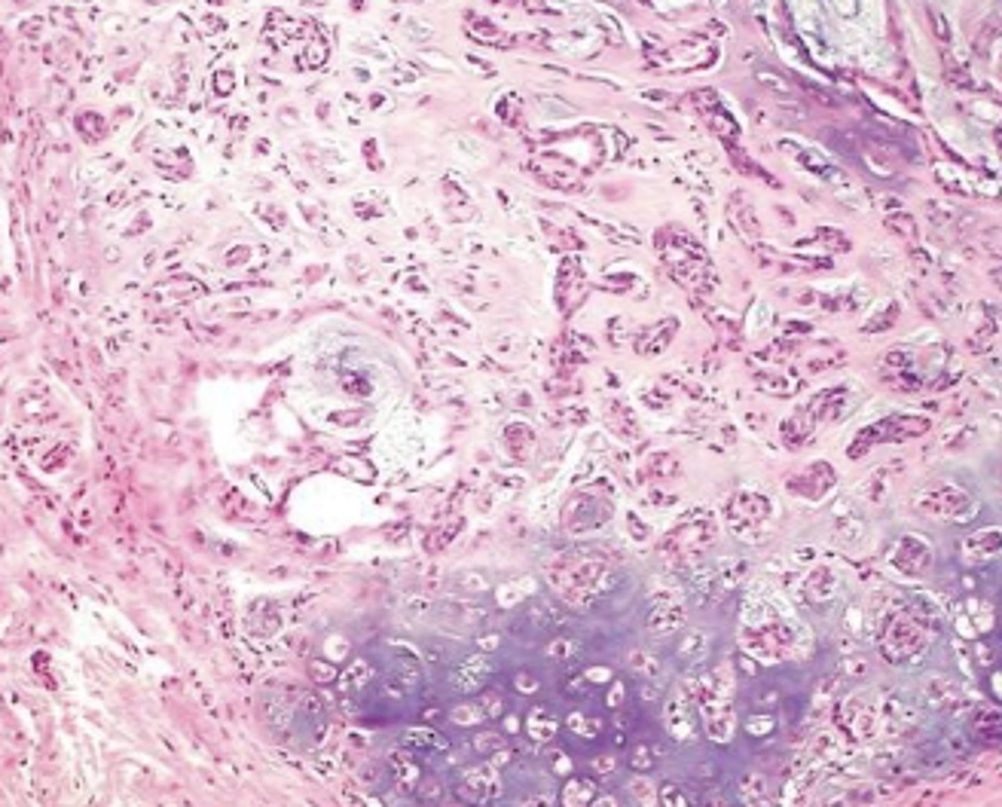 <p>What kind of tumor is this?</p>