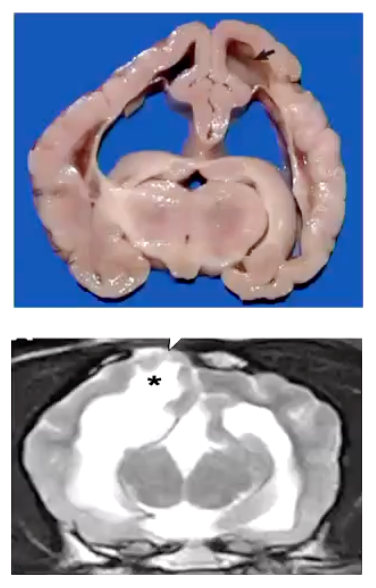 <p><strong>• Same physiopathology than hydranencephaly but the cavity formed is smaller</strong></p><p><u>• The insult occurs later on the developmental stage.</u></p><ul><li><p>E.g.: fetal lamb with bluetongue infection from 50-55 days = hydranencephaly. Compared with porencephaly which occurs when infection at 75-78 days. And infection after 100days of pregnancy cause mild encephalitis in the fetus, with no malformation.</p><ul><li><p>The insult affects to a smaller region of the brain.</p></li></ul></li></ul><p><strong>• Usually clinically normal or just seizures in adulthood (<3y of age in dogs)</strong></p>