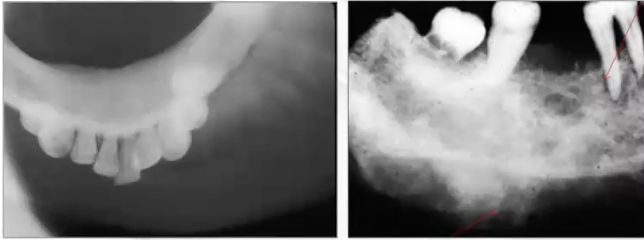 <p>A sunburst appearance (d/t bony projections on the surface of the lesion) would be best appreciated using an <strong>occlusal x-ray</strong></p>