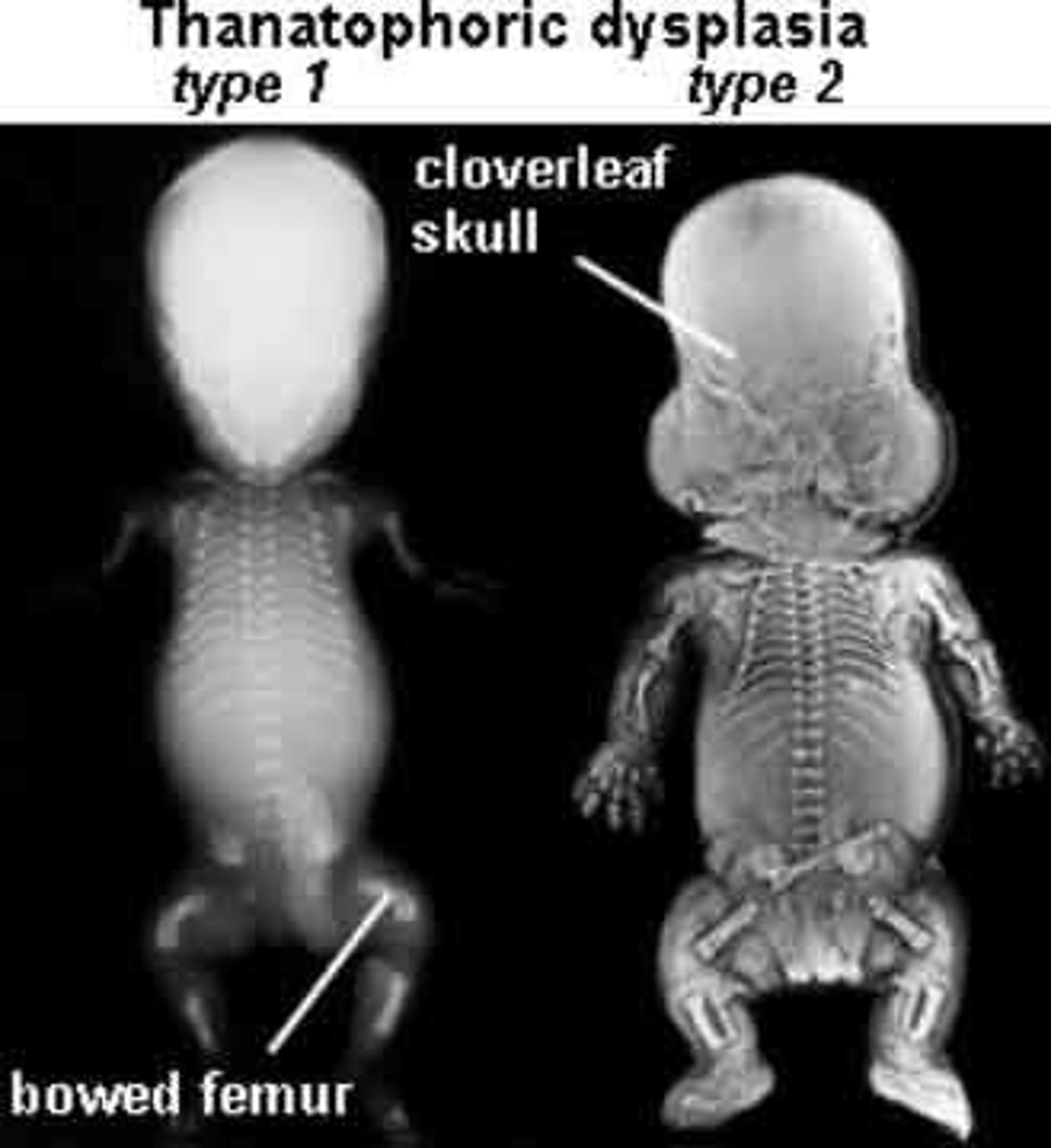 <p>The most common lethal skeletal dysplasia, with Type I showing platyspondyly and curved femurs, and Type II showing straight femurs, and a cloverleaf skull.</p>