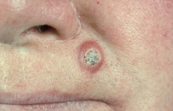 <p>what is the most likely diagnosis </p>
