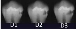 <p>involves DEJ or extends through </p>