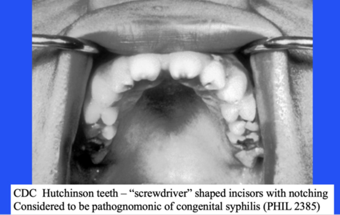 <p>Hutchinson's teeth (screwdriver shaped incisors)</p>