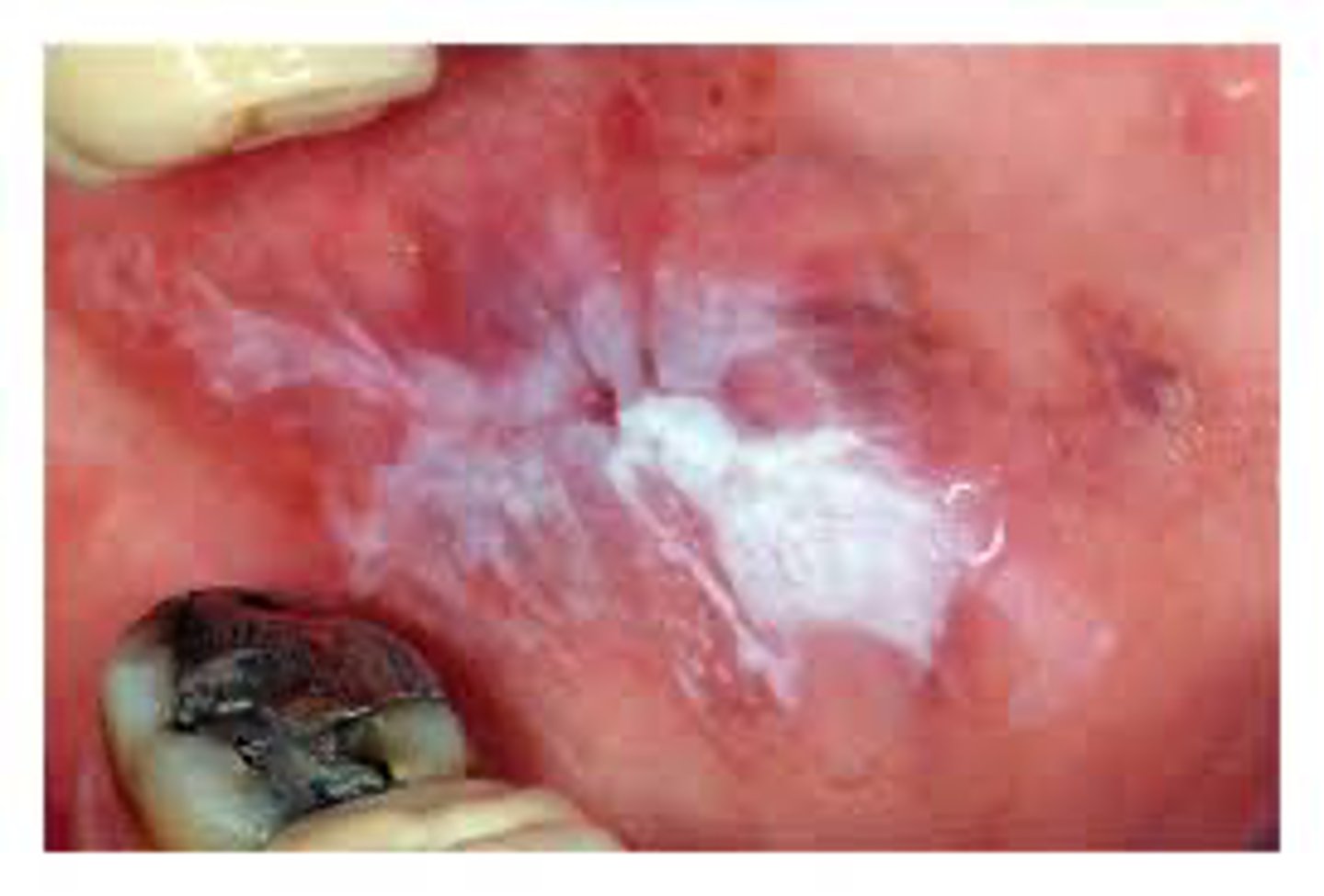 <p>A patient presents with white striations on the buccal mucosa. The lesion is unilateral and located adjacent to a dental restoration.</p><p>What is the most likely diagnosis?</p>