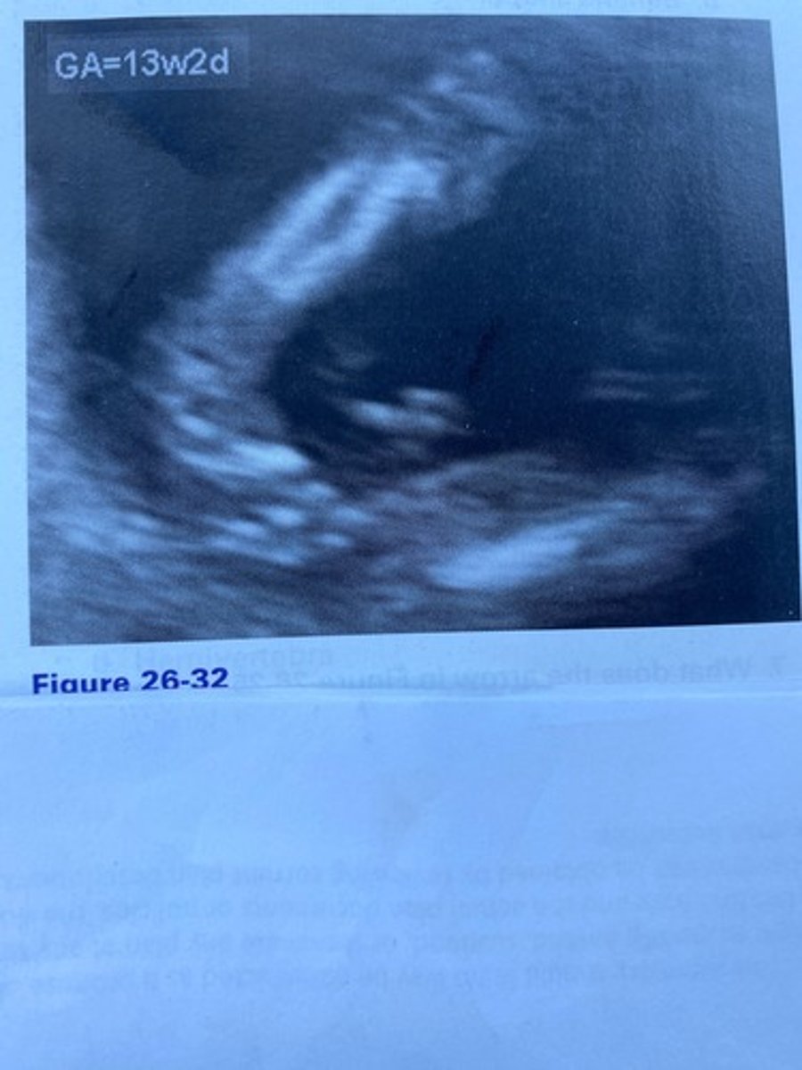 <p>What abnormality of the lower leg is evident in</p><p>Figure 26-32?</p><p>a. Amelia</p><p>b. Phocomelia</p><p>c. Clubfoot</p><p>d. Syndactyly</p>
