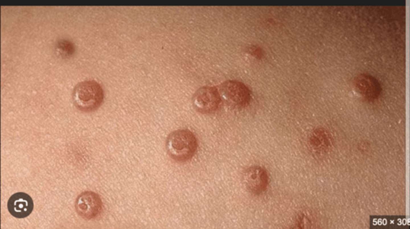 <p>- pearly white/pink papule with a central umbilication</p><p>- appear in clusters on the body (EXCEPT palms and soles)</p>