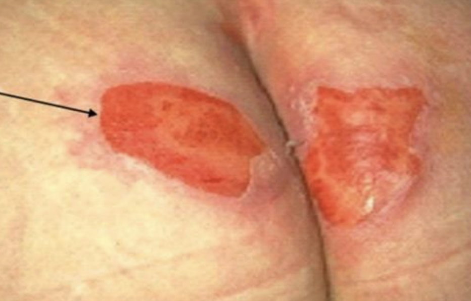 <p>pressure injury stage</p>