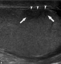 <p>This scan was performed on a patient whose been feeling pain and swelling around the area. What can be assumed here?</p>