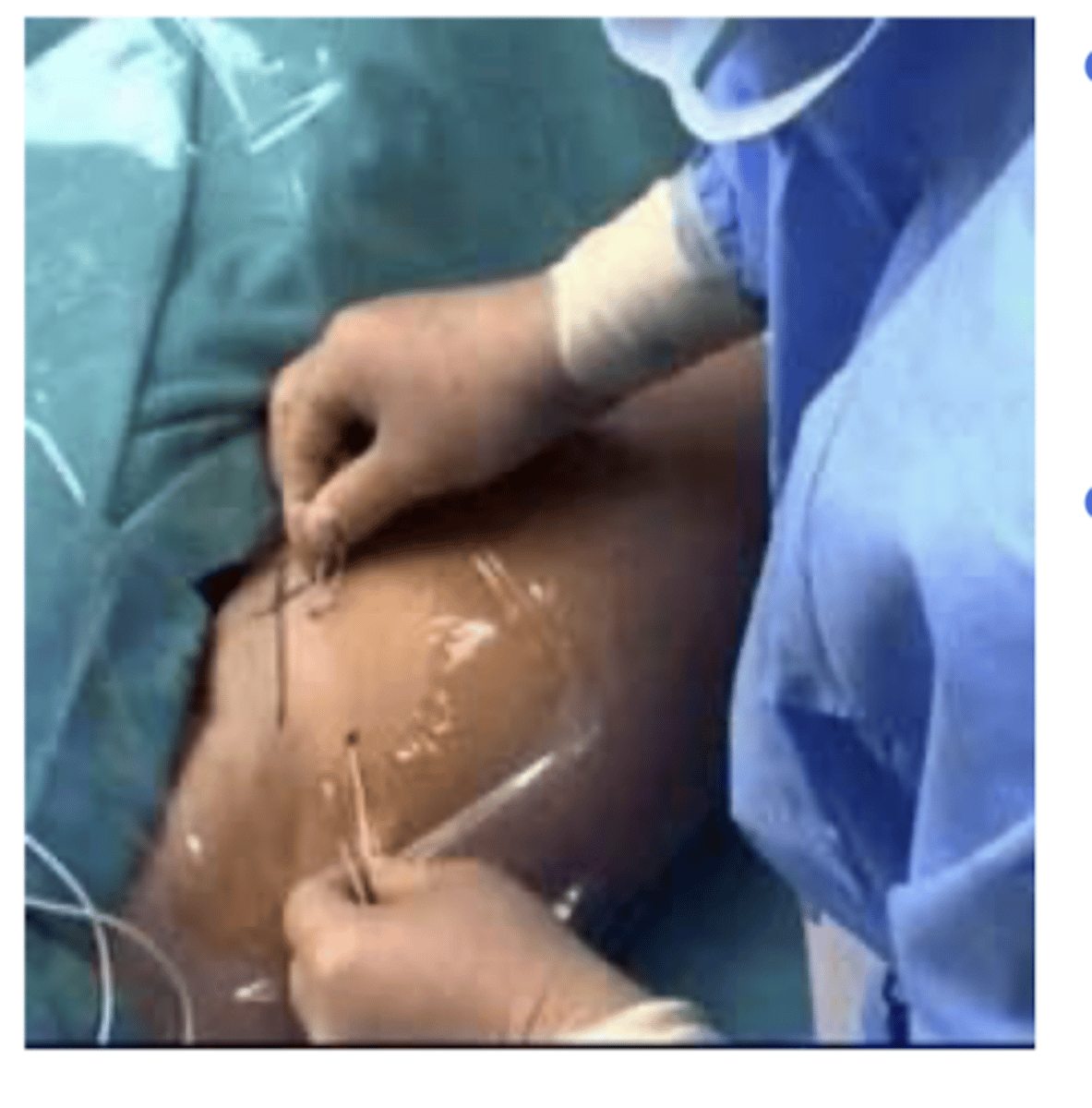 <p>Catheter inserted near femoral nerve for post op pain control after knee TKA</p>