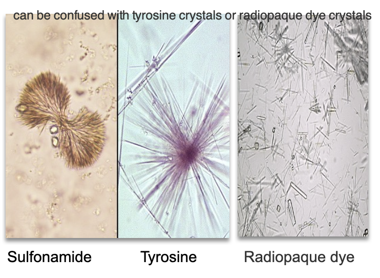 <ul><li><p class=""><strong>Can be mistaken for</strong>:</p><ul><li><p class=""><strong>Leucine</strong> (spheroid, yellow concentric rings)</p></li><li><p class=""><strong>Tyrosine</strong> (fine needle sheaves/rosettes)</p></li><li><p class=""><strong>Radiographic dye</strong> (flat needles, high SG, birefringent)</p></li></ul></li><li><p class=""><strong>Clue</strong>: Sulfa crystals typically brown; patient history + hydration status helps confirm diagnosis. </p><p class=""></p></li></ul><p></p>
