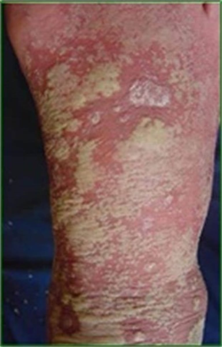 <p>this a rare subtype of generalized pustular psoriasis</p>
