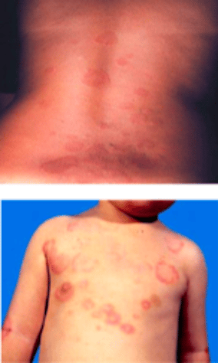 <p>Exanthems:</p><p>The following are criteria needed to Dx what:</p><p>Modified Jones Criteria:</p><p>5 major manifestations:</p><p>1. Arthritis</p><p>2. Caritis and valvulitis</p><p>3. CNS involvement</p><p>4. Subcutaneous nodules</p><p>5. Erythema marginatum (easily mistaken for regular urticaria/hives)</p><p>4 minor manifestations:</p><p>1. Arthralgia</p><p>2. Fever</p><p>3. Elevated acute phase reactants, C-reactive protein</p><p>4. Prolonged PR interval on electrocardiogram</p><p>Pt needs at least 2 major criteria to be diagnosed, or 1 major and 2 minor criteria</p>