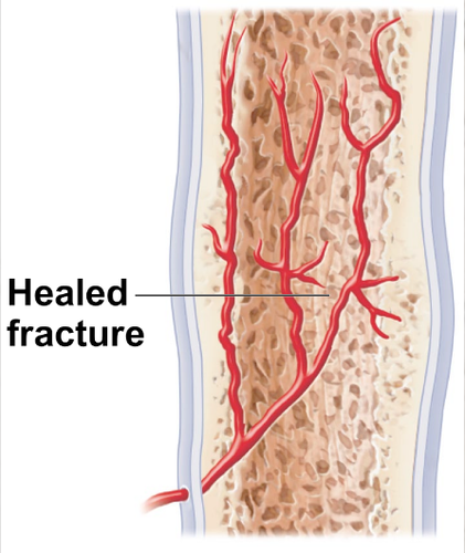 fourth and final stage of healing a bone fracture. bony callus is remodeled in response to the mechanical stresses placed on it, so that it forms a strong, permanent patch at fracture site.