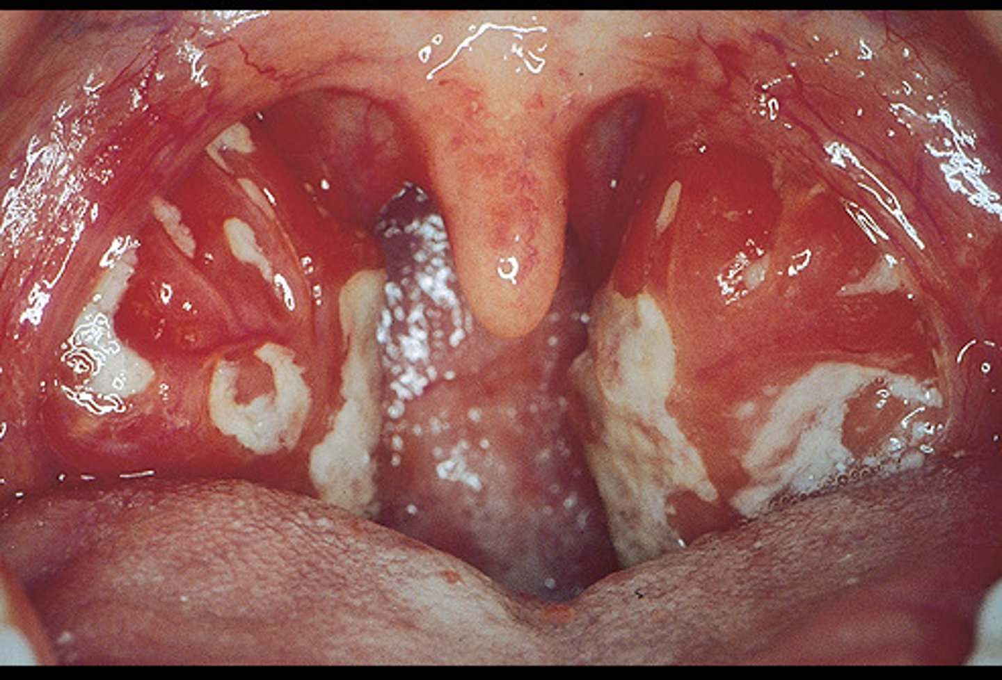 <p>Caused by the Epstein-Barr virus, and characterized by fever, a sore throat, and enlarged lymph nodes.</p>
