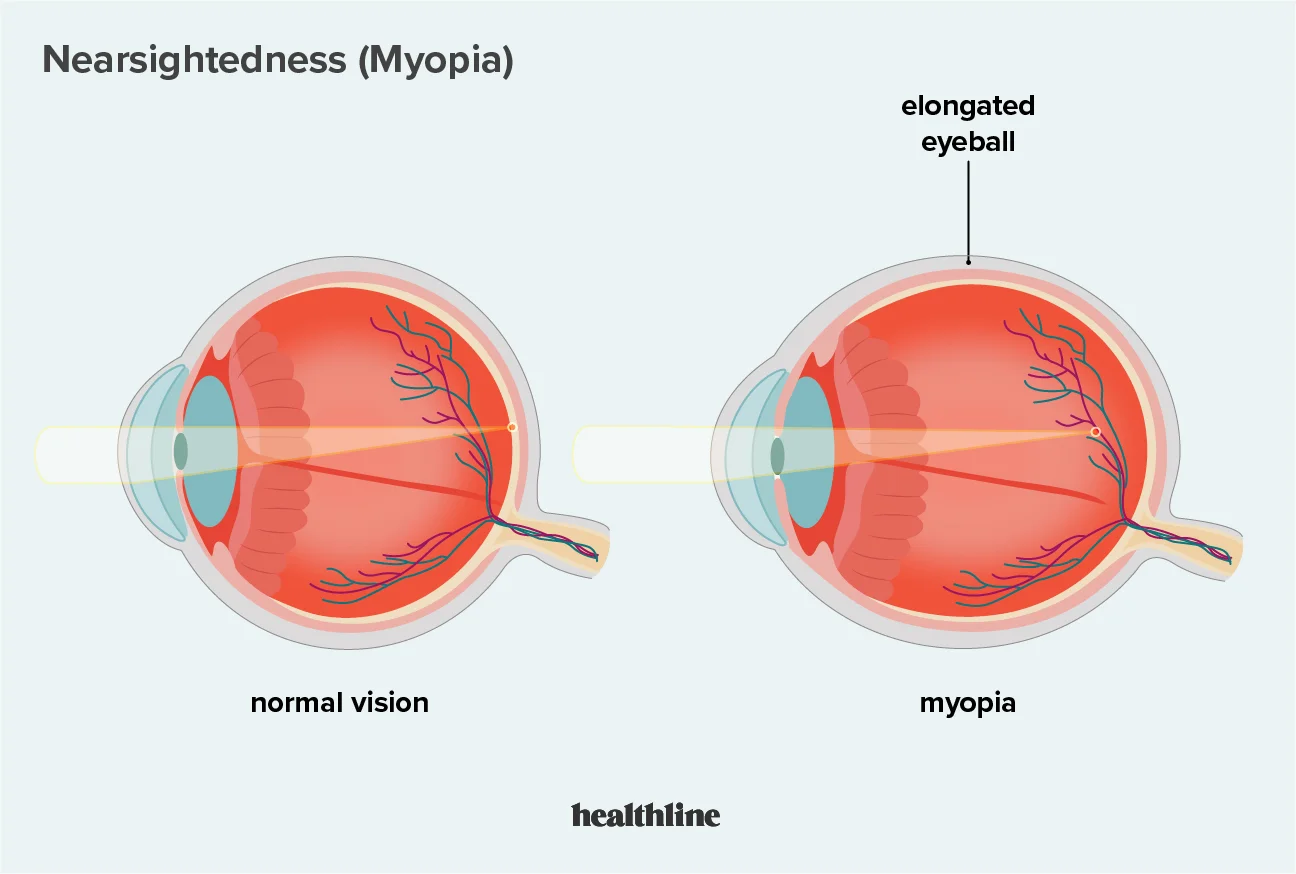 <p>Common vision condition in which close objects look clear but far objects look blurry</p><ul><li><p>Light doesn’t reach on the back of the eye (retina)</p></li><li><p>Diverging (Concave lenses)</p></li></ul>