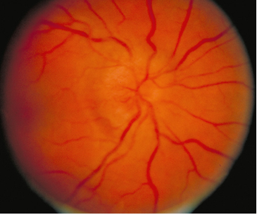 <p><span><em>A 28-year-old former gymnast noticed difficulty seeing fine lines with her left eye. The symptoms progressed over the next day, and she had difficulty reading newspaper headlines. Pain in the left orbit was minor at first but worsened and increased with eye movement.</em></span></p><p style="text-align: left"><span><em>Vision was 20/200 in the left eye and 20/30 in the right eye. There was a central scotoma (blind spot), and red was less intense in the left eye.</em></span></p>
