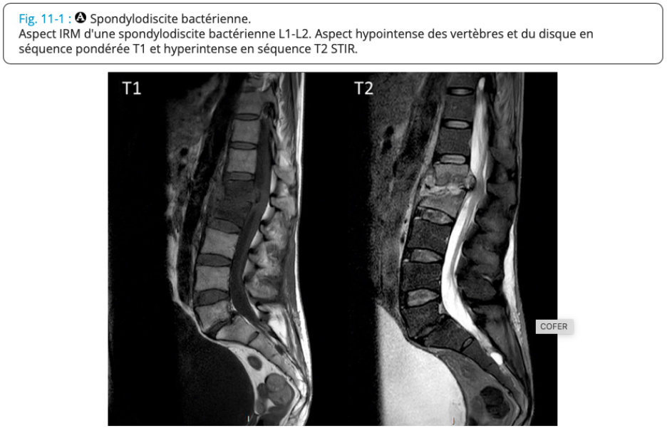 <p>= infection d’un disque intervertébral et des corps vertébraux adjacents</p><p>Radio : normale (début) puis décalage radio-clinique 3-4sem</p><p>IRM (exam réf diag précoce) : hypersignal du disque et des plateaux vertébraux adjacents, abcès périvertébraux ou épidurite → séquences STIR ou T1 après inj gado / hyposignal en T1</p><p>Scanner = si IRM CI, guidage ponction-biopsie discovertébrale</p><p>Scintigraphie et TEP-scanner : si IRM CI</p>