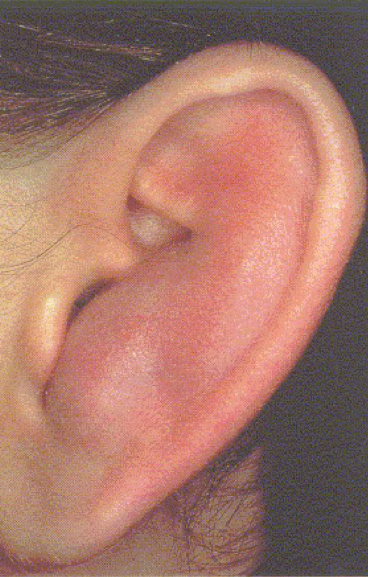 <p><u>disordered otoscopy: pinna</u></p><p>auricular hematoma</p>