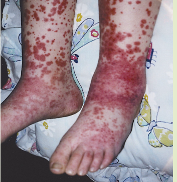 <p><strong>Henoch-Schonlein Purpura: Symptoms</strong></p><p>-Palpable ________ (hallmark) </p><ul><li><p>Most often below the ______, found on the buttocks and lower extremities </p></li><li><p>May start as _________ or urticarial lesions then progress to purpura </p></li><li><p>Non-blanching, non-thrombocytopenic </p></li></ul><p>-Edema </p><ul><li><p>Mostly of _______, dorsum of feet, scalp, scrotum, and/or labia </p></li></ul><p>-Arthritis </p><ul><li><p>Mostly in ______ extremity, with the ankle and ______ being the most common sites </p></li><li><p>Acute and very _________ (often won’t bear weight)</p></li></ul><p>-GI Symptoms</p><ul><li><p>Mild-moderate crampy abdominal _____</p></li><li><p>Bloody _______, distention, and perforation are possible but rare </p></li></ul><p>-Renal disease </p><ul><li><p>Glomerulonephritis → hematuria, HTN, acute renal failure </p></li></ul><p>-Rarely associated with encephalopathy, pancreatitis, and orchitis </p><p></p>