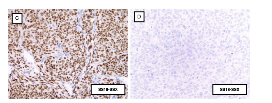 <p>pathologists to diagnose synovial sarcoma</p><ul><li><p>immunohistochemical staining is accomplished with antibodies that recognize the target antigen on tissue slices and are then developed to produce a dark staining where the target protein is located</p></li><li><p>sample C = SS18-SSX positive → staining</p></li><li><p>sample D = SS18-SSX negative → no staining</p></li></ul><p></p>