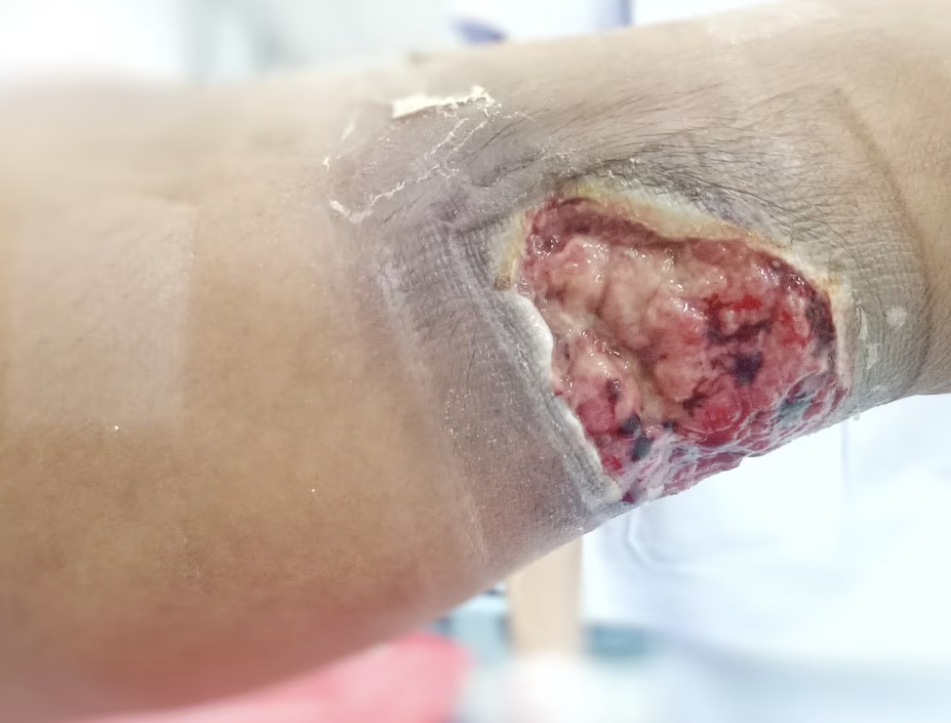 <p>what stage of pressure wound is this?</p>