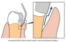 <p><span><strong> Explorer must move away from tooth and over the restoration</strong></span></p><p><span><strong> “Skating over a section of a sidewalk that is higher than the adjacent </strong></span><strong>section”</strong></p>