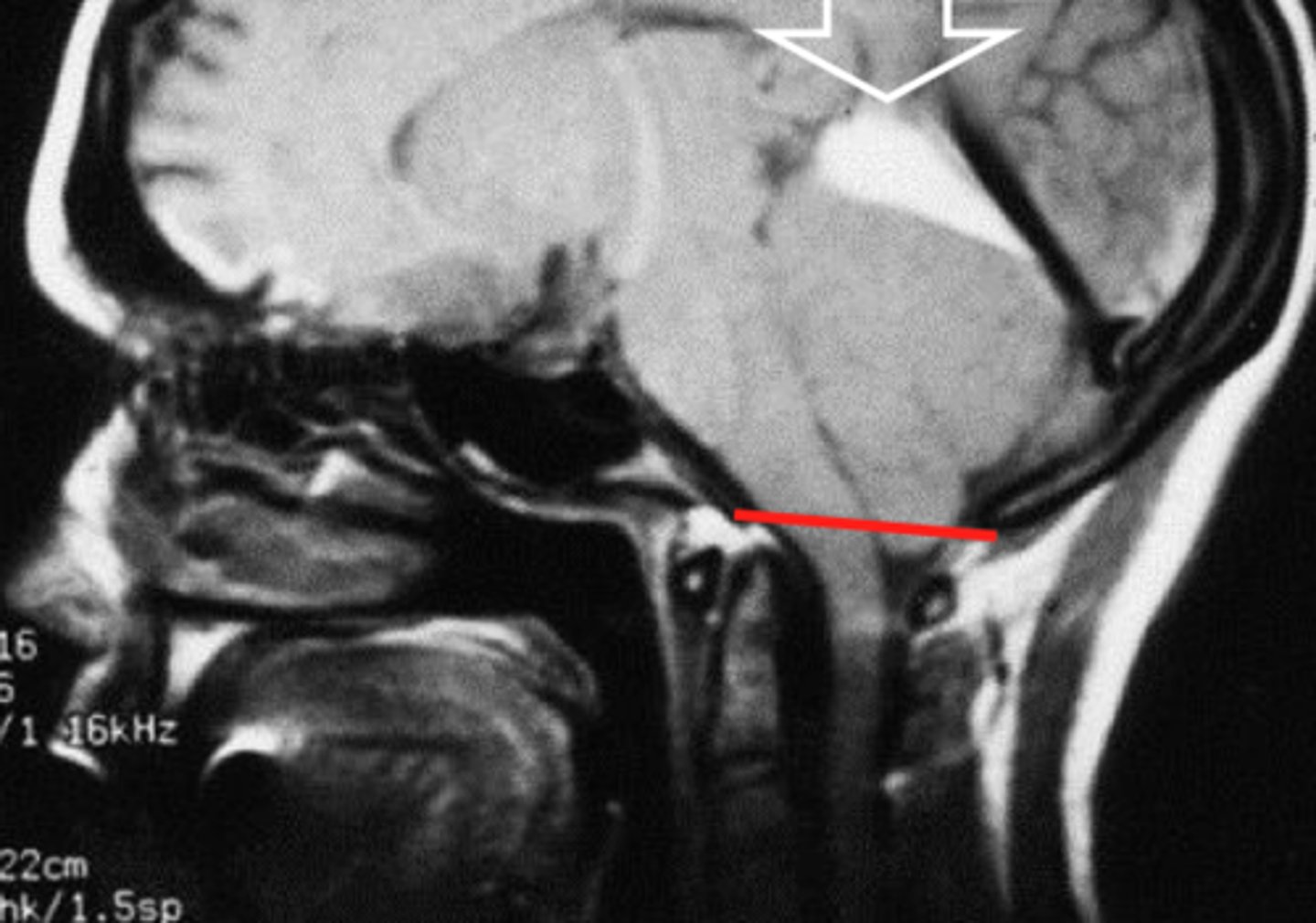 <p>herniation of the brain where cerebellar tonsils descend through the foramen magnum</p>