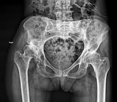 <p>is known as developmental hip dysplasia. result from incomplete acetabulum formation caused by physiologic and mechanical factors.</p>