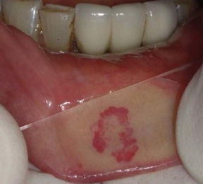 <p>Where do majority of hemangiomas occur?</p>