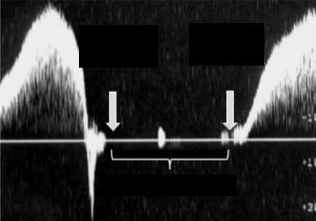 <ol><li><p>What movement is being performed for the waveform to appear this way?</p></li><li><p>Does this show if the vein is competent or incompetent?</p></li></ol><p></p>