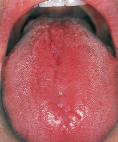 <p>refers to papillary atrophy of the tongue</p><p>characterized by an absence of <span style="color: red;">filiform and fungiform papillae</span></p><ul><li><p><strong>treatment:</strong></p><ul><li><p>treatment <span style="color: red;">varies depending on the underlying cause</span> of the condition</p></li></ul></li></ul><p></p>