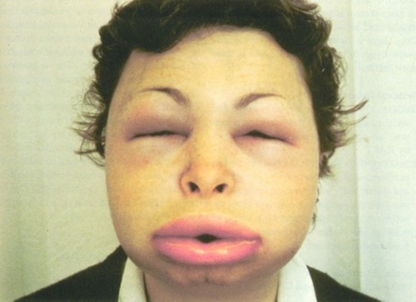 <p>Anafilaxia</p>