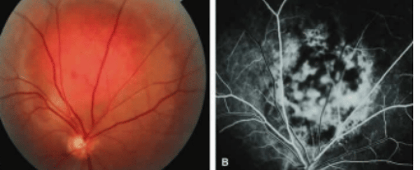 <p>a benign vascular tumor of the choroid. No treatment unless there is macular involvement or extensive fluid leakage. Laser therapy and irradiation is available.</p>