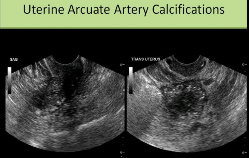 <p>a <strong>60 yo</strong> has hx of intermittent pelvic pain. the exam is normal except for the <strong>multiple small echogenic foci</strong> in the <strong>myometrium</strong>. which is the most common cause  </p><p>.</p><p>a) systemic HTN</p><p>b) acute PID</p><p>c) diabetes</p><p>d) stein-levanthal syndrome</p>