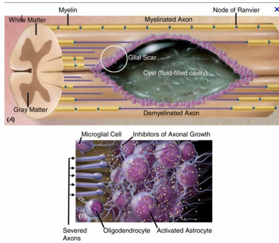 <ul><li><p>response to injury</p></li><li><p>astrocytes infiltration and proliferation may result in formation of astrocytic scar</p></li><li><p>CNS injury such as stroke, SCI, and neurodegenerative disease such as multiple sclerosis </p></li><li><p>may restrict regenerative capacity of CNS </p></li></ul><p></p>
