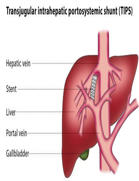 <ul><li><p><strong>redirect portal flow through the shunt </strong></p></li><li><p>decrease portal venous pressure</p></li><li><p>reduct pressure gradient across liver </p></li></ul><p></p>