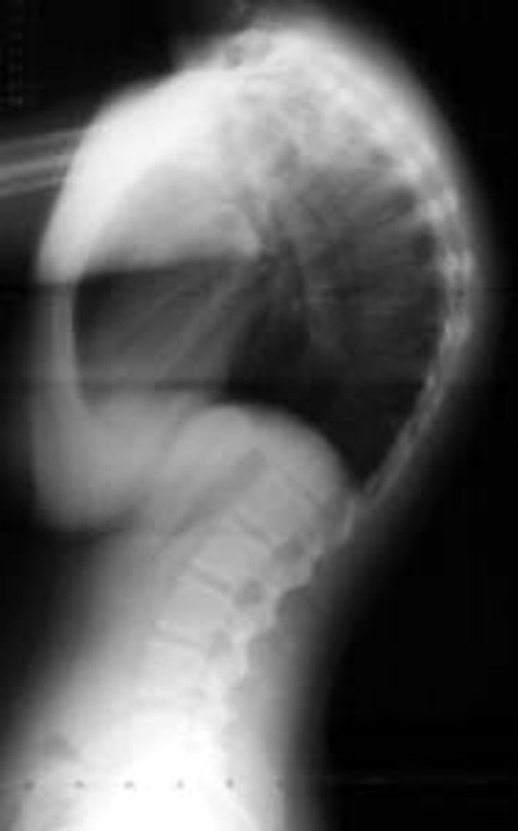 <p>Vignette # 6</p><p>Sex: Male</p><p>Age: 28</p><p>Chief Complaint: Patient presents with asthma and reports a history of corticosteroid use.</p><p>Objective Findings: Later flexion is limited Diagnostic imaging: X-ray</p><p>2. List the appropriate follow up step. (Choose 3)</p><p>a. Surgical consult</p><p>b. Extension rehab</p><p>c. Strengthen flexors</p><p>d. William's exercises</p><p>e. Milwaukee brace</p><p>f. Adjust</p><p>g. Spinal stretching exercises</p><p>h. Defer adjusting</p>