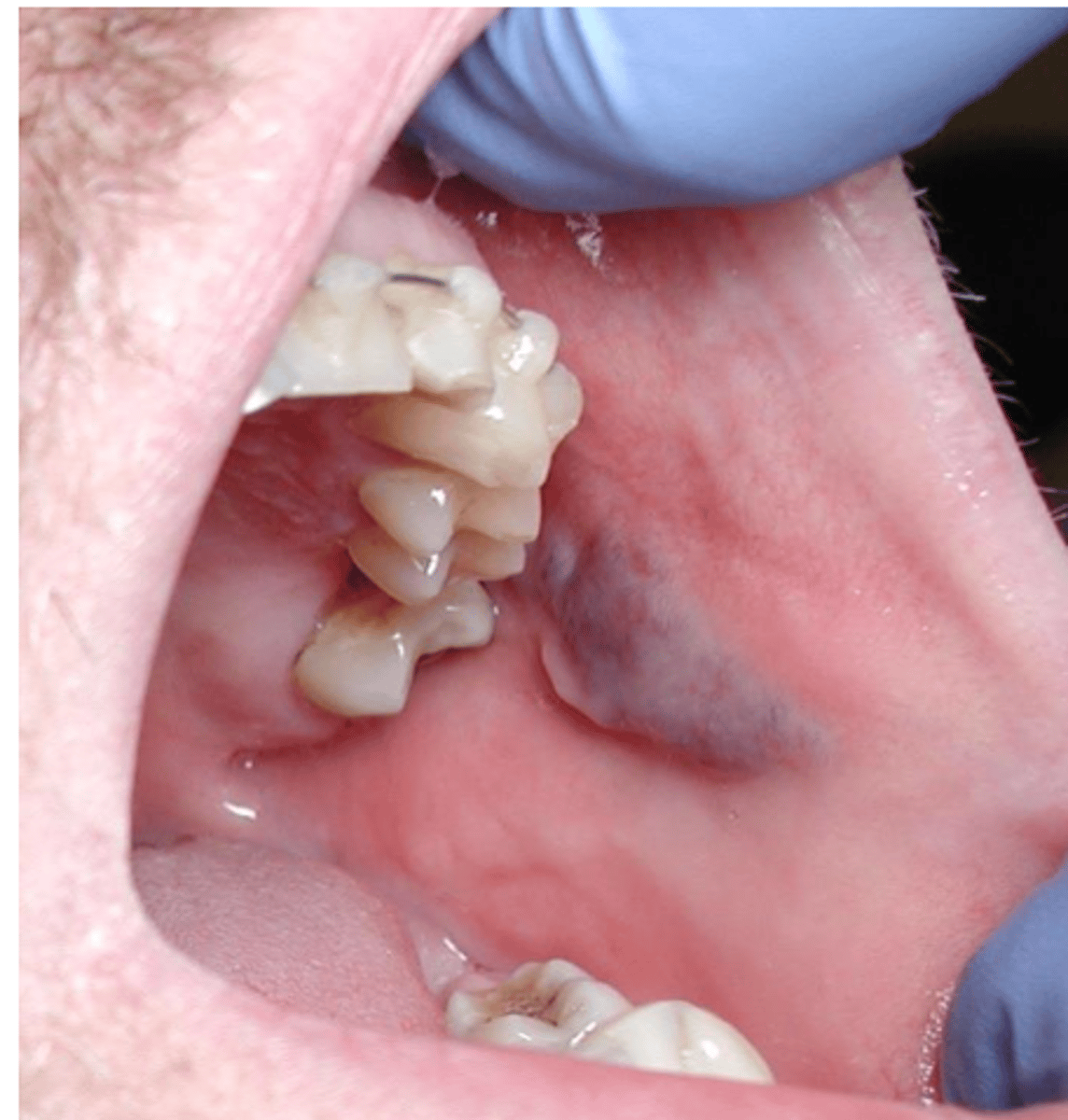 <p>Vascular malformation - treatment</p>