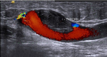 <p>what category of thrombus is this</p>