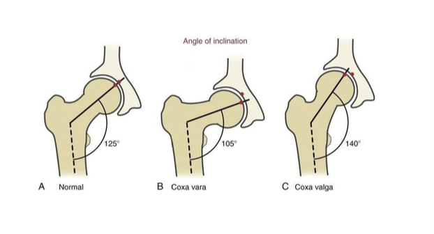 <p>frontal plane angle between femoral neck and medial side of the shaft</p>