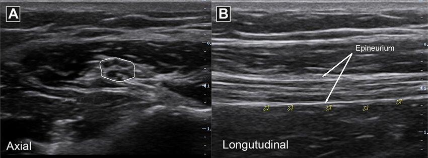 <p>'Honey-comb' appearance in transverse view; 'train track' in longitudinal view</p>