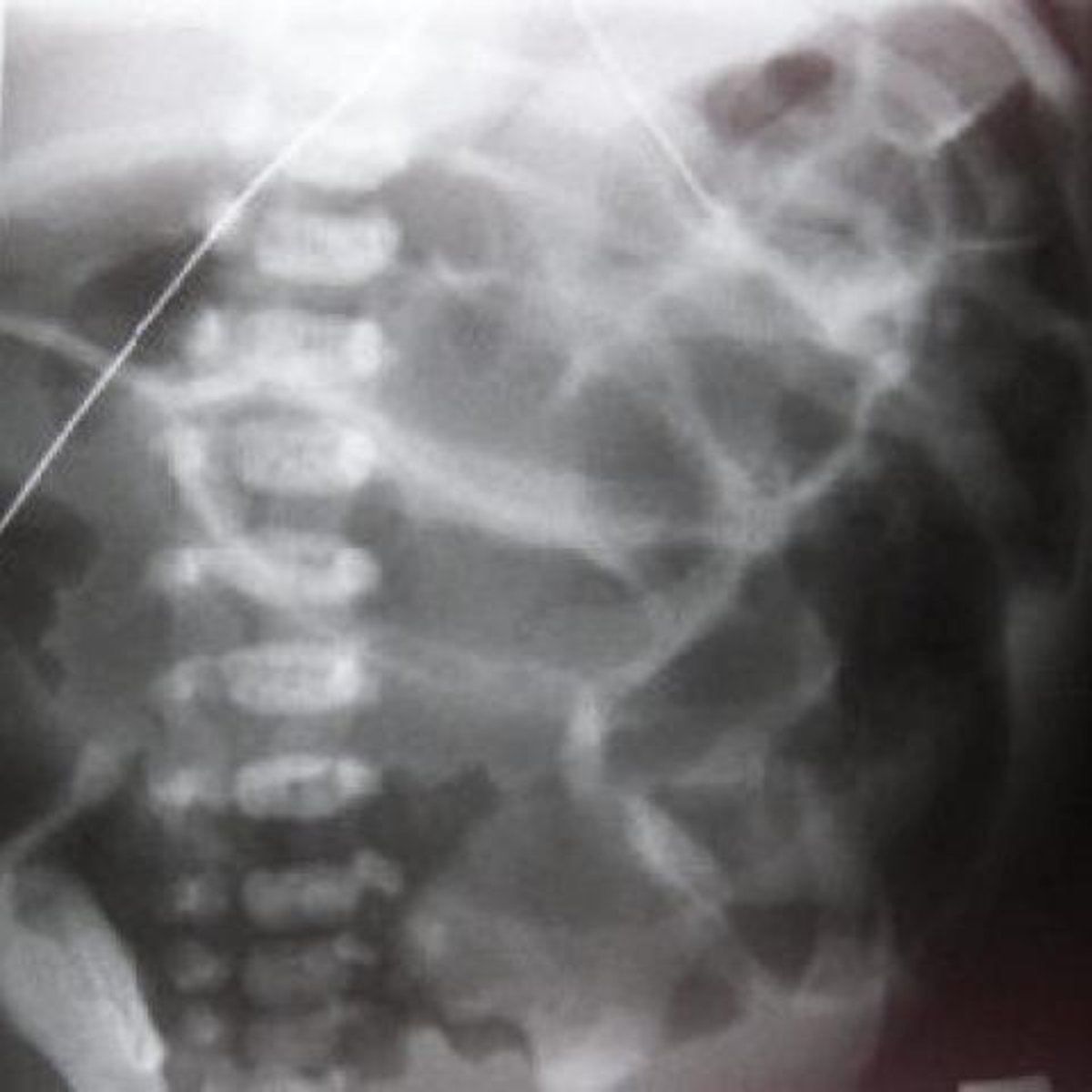 <p>Steatorrhea and failure to thrive due to malabsorption.</p>
