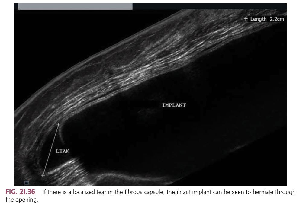 <p></p><p class=""><strong>Acute Complications (early, soon after implantation):</strong></p><p> </p><ul><li><p class=""><strong>Pain/tenderness</strong>.</p></li><li><p class=""><strong>Loss of nipple sensation</strong>.</p></li><li><p class=""><strong>Hematoma</strong>.</p></li><li><p class=""><strong>Abscess</strong>.</p></li><li><p class=""><strong>Seroma</strong>.</p></li></ul><p> </p><p class=""><strong>Chronic Complications (may develop years later):</strong></p><p> </p><ul><li><p class=""><strong>Capsular fibrosis/contracture</strong>: The fibrous capsule around the implant hardens and tightens, which can distort the shape of the breast.</p></li><li><p class=""><strong>Herniation</strong>: A tear in the fibrous capsule may cause the implant to protrude or move (palpable and identifiable via sonography or MRI).</p></li><li><p class=""><strong>Migration</strong>: The implant moves from its original position.</p></li><li><p class=""><strong>Rupture</strong> (Intracapsular or Extracapsular): The most common complication, especially with <strong>silicone implants</strong>.</p></li><li><p class=""><strong>Silicone granuloma</strong>: When silicone leaks into the surrounding tissue, forming a localized inflammatory response.</p></li><li><p class=""><strong>Chronic infection</strong>: This can result in prolonged inflammation or damage.</p></li></ul><p></p>