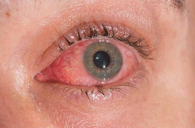 either viral or bacteria infection that inflames the conjunctiva (membranes around the eyelids and eyeball)