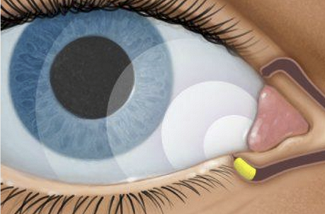 <ul><li><p>0.4 mg dexamethasone intracanalicular insert</p></li><li><p>FDA approved for: inflammation and pain following ophthalmic surgery &amp; allergic conjunctivitis</p></li><li><p>Sustained release for 30 days </p></li><li><p>Improved compliance vs. ~70 drops in 30 days </p></li><li><p>No need for removal, disintegrates and flushed thru nasolacrimal system </p></li></ul><p></p>