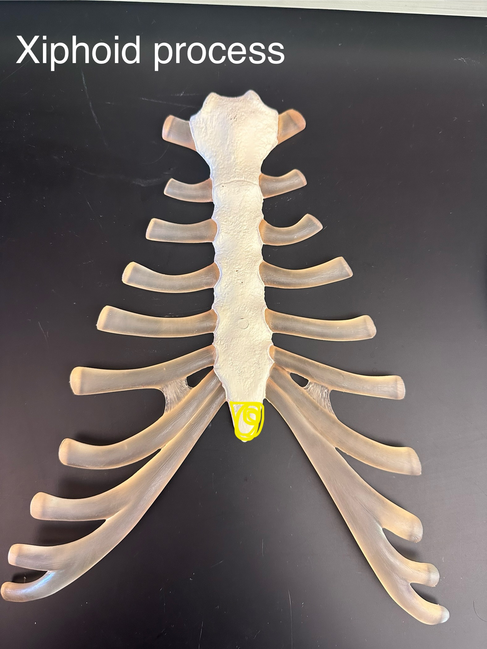 <p>Xiphoid process</p>