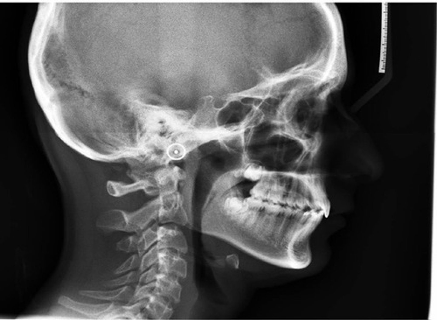 <p>extraoral radiograph of the bones & tissues of the head</p>