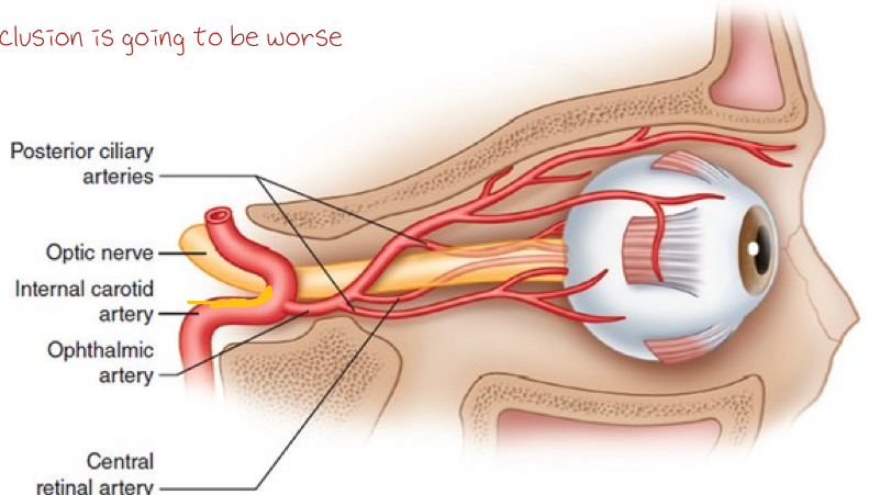 <p>mild carotid artery stenosis (15-49% of carotid artery occluded)</p><ul><li><p>the side without the occlusion is going to be worse</p></li></ul><ul><li><p>moderate-severe carotid artery stenosis also leads to asymmetric diabetic retinopathy, but too much hypoxia</p></li></ul><p></p>